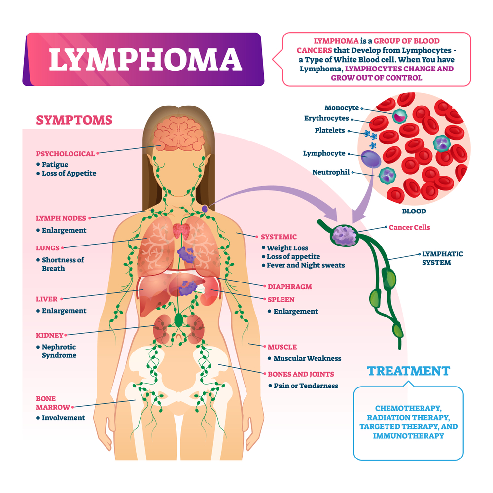 Intestinal lymphoma