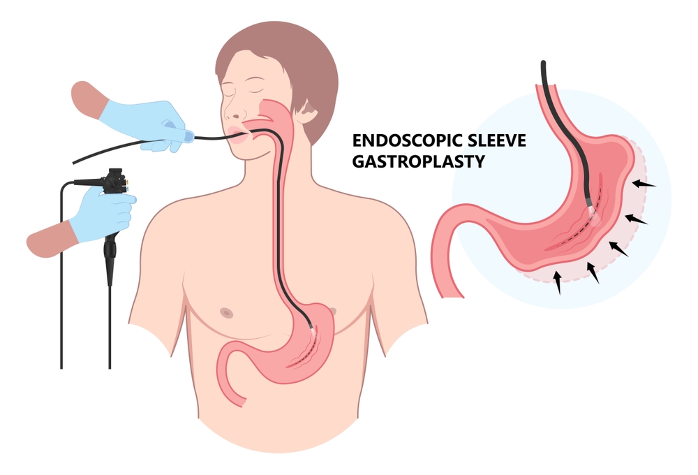 endoscopy