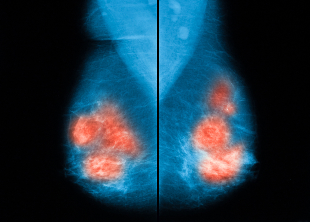 Bilateral Breast Cancer